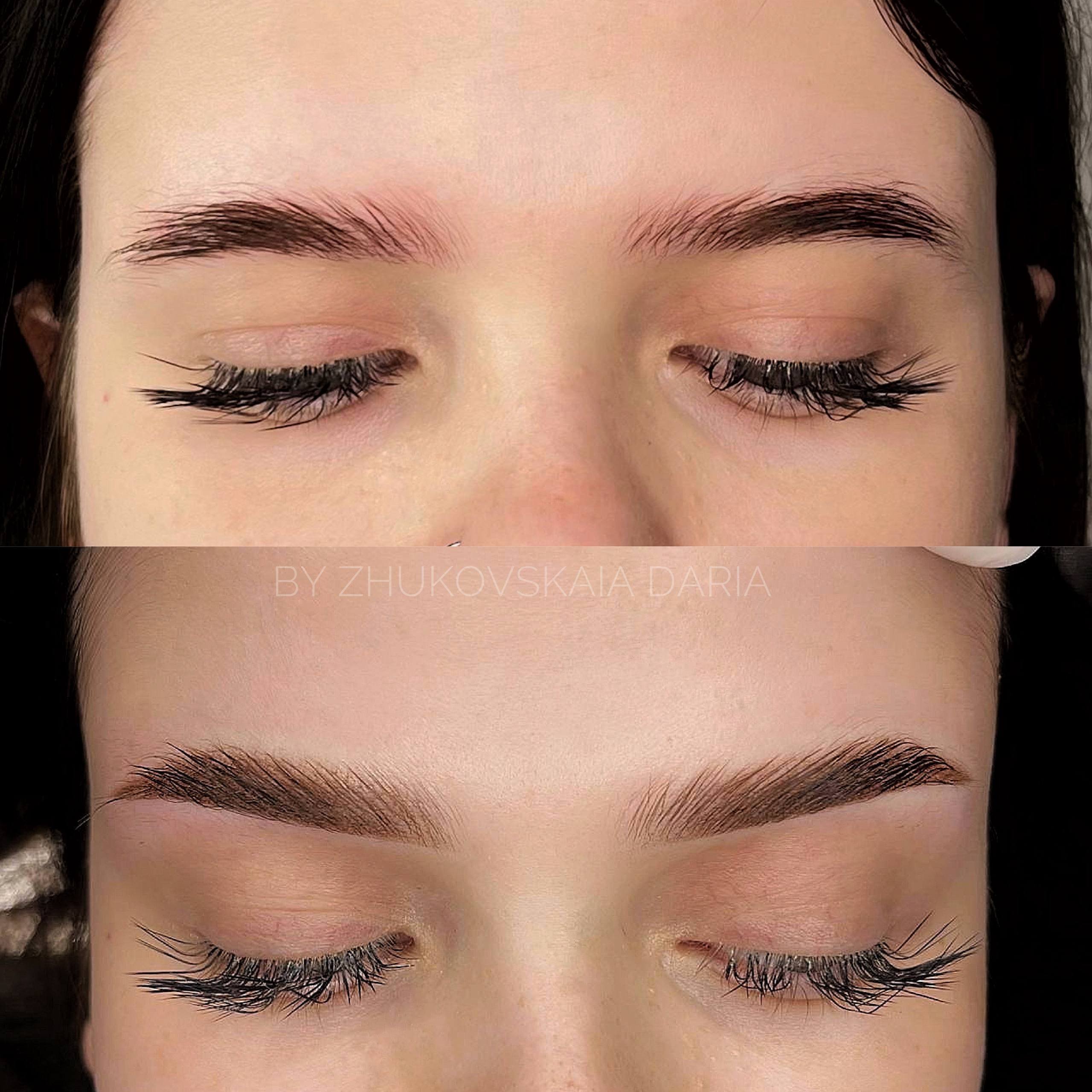 Permanent makeup and tattoo removal (dermopigmentation) — Bali, Indonesia